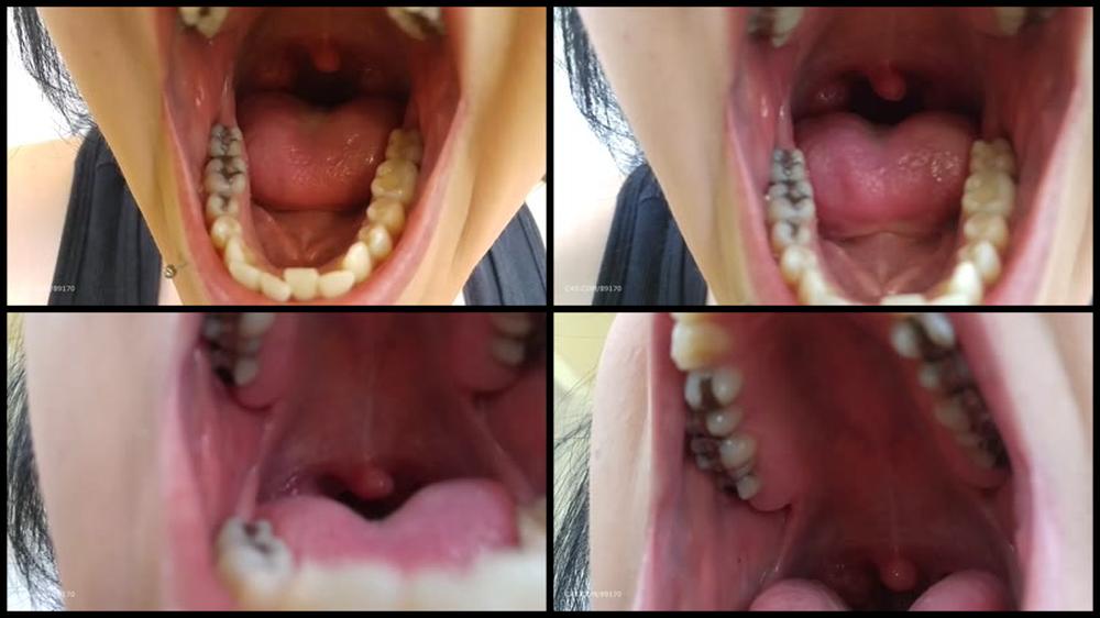 Booty4U Teeth Update