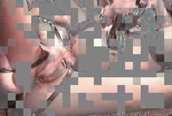 Anal_Fister10