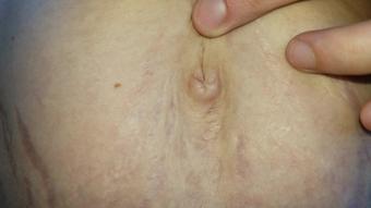 Belly Button Hiccups CUSTOM VID