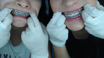 Miaisabella3 Mouth Teeth Braces Inspection
