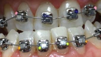 braces and pierced tongue close up - November 13, 2019