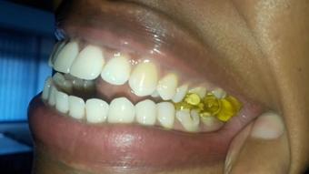Gummy bear swallow - April 23, 2022
