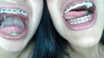 Miaisabella3 Braces Mouth Uvula Fetish