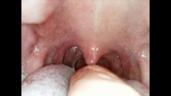 Endocam swallowing food - February 19, 2023