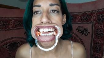 Mouth retractor eating n drooling - April 26, 2021