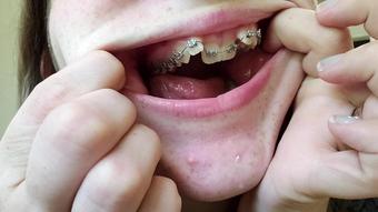 Mouth Spit And Braces Worship
