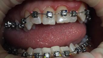 braces with elastic close up - November 28, 2019