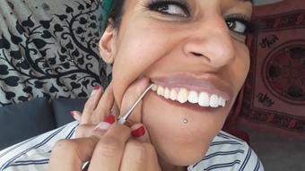 Teeth scraping - May 21, 2021